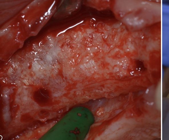 Bone graft for dental implant, after