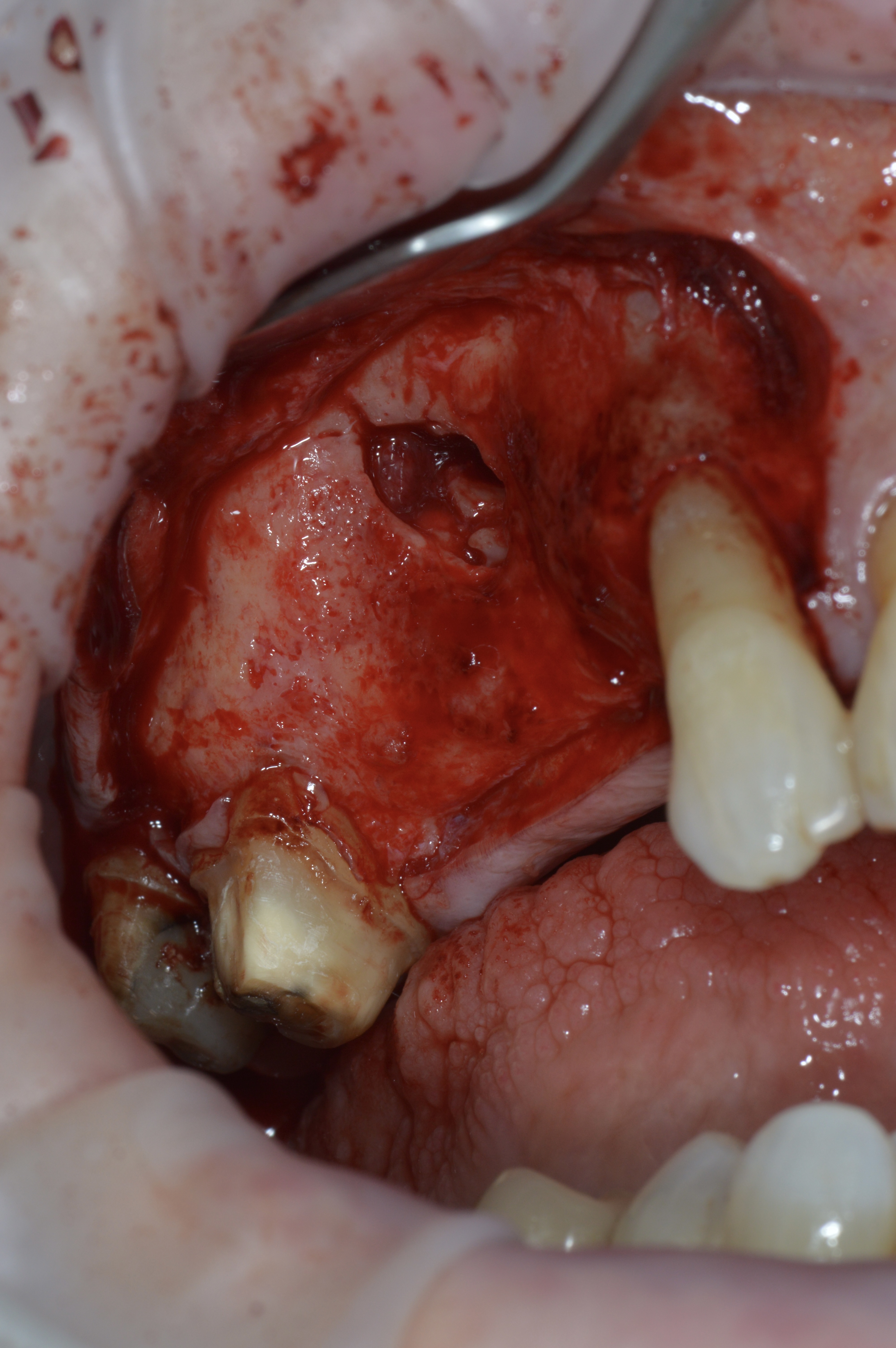 Bone graft for dental implant, before