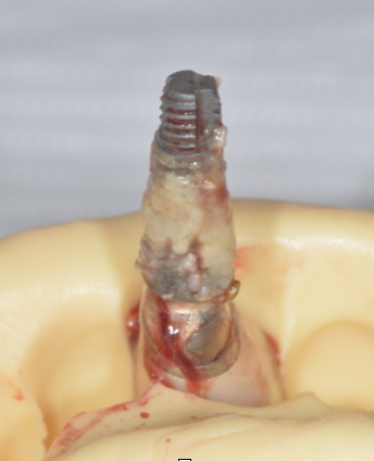 Failed Implant