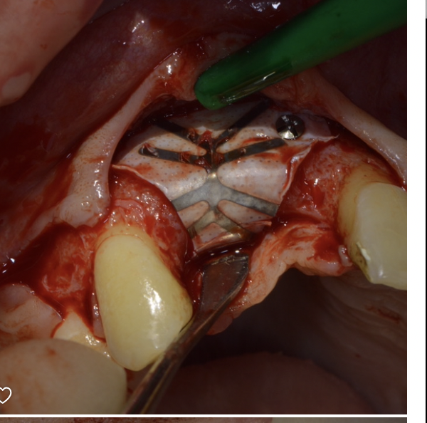 Guided Bone Regeneration