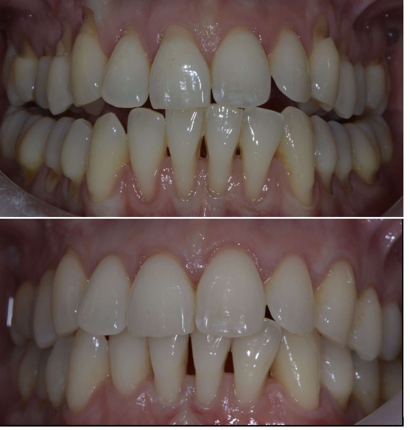 Gum recession correction, before and after