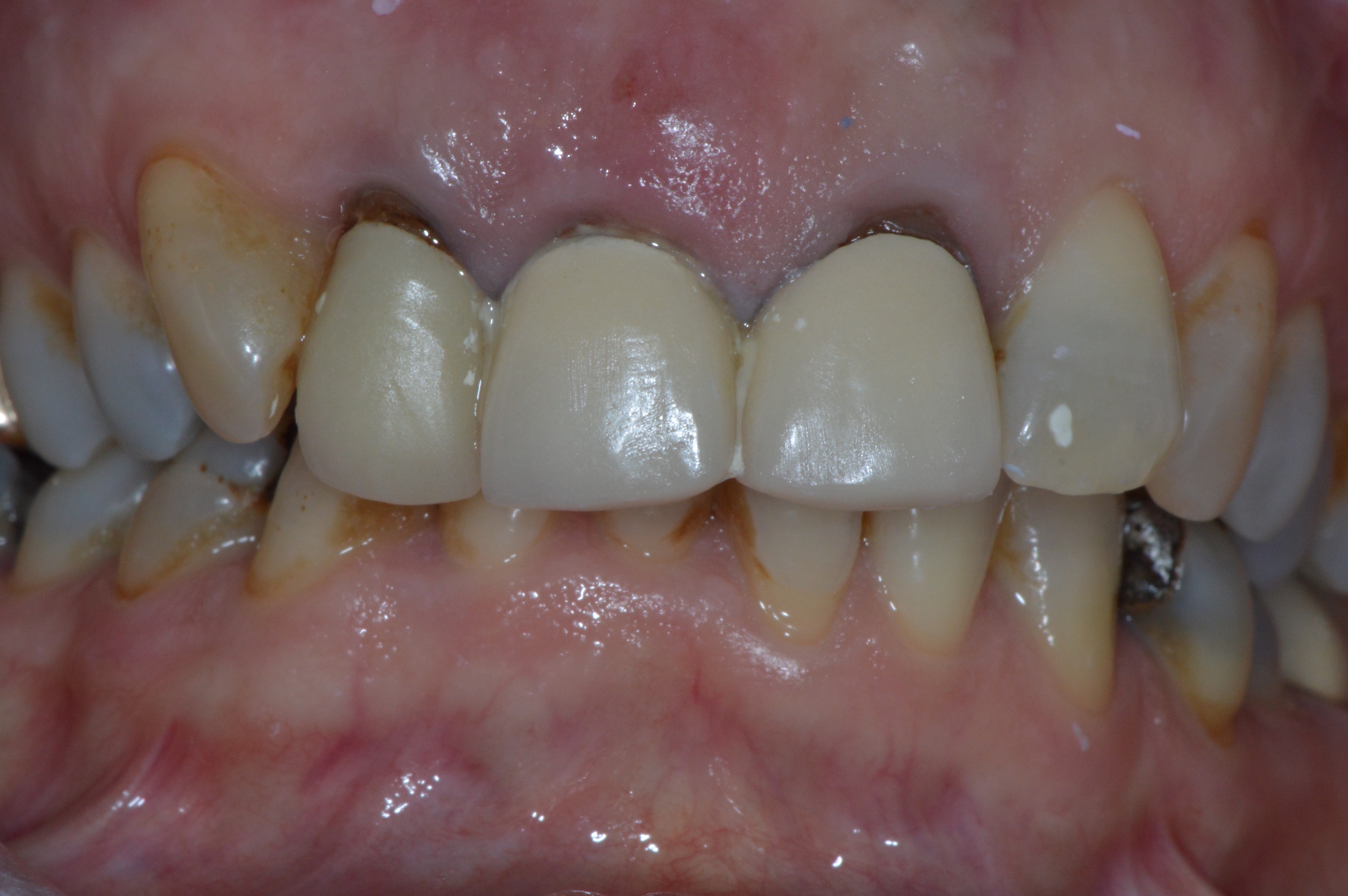 Implant case, before treatment