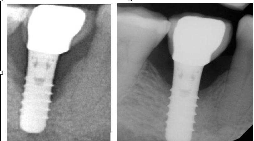 Peri-implantitis, implant x-ray comparison