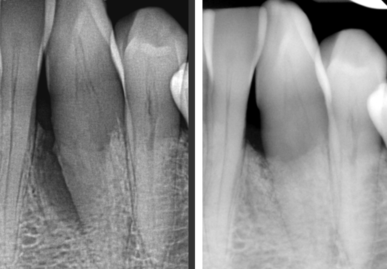 Periodontal regeneration, x-ray before and after